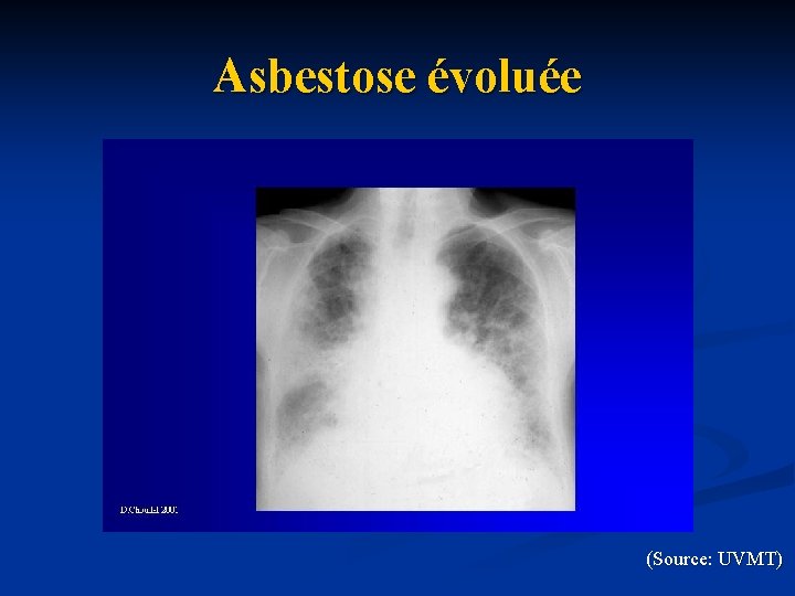 Asbestose évoluée (Source: UVMT) 
