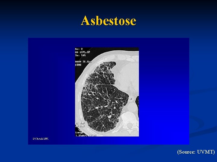 Asbestose (Source: UVMT) 