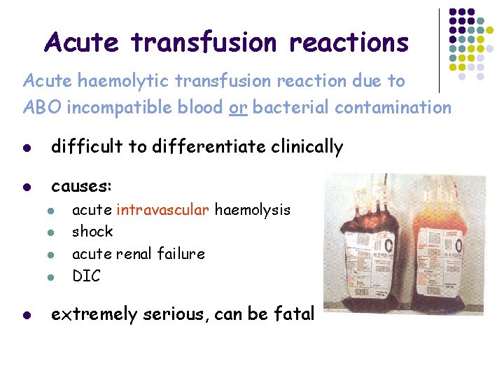 Acute transfusion reactions Acute haemolytic transfusion reaction due to ABO incompatible blood or bacterial