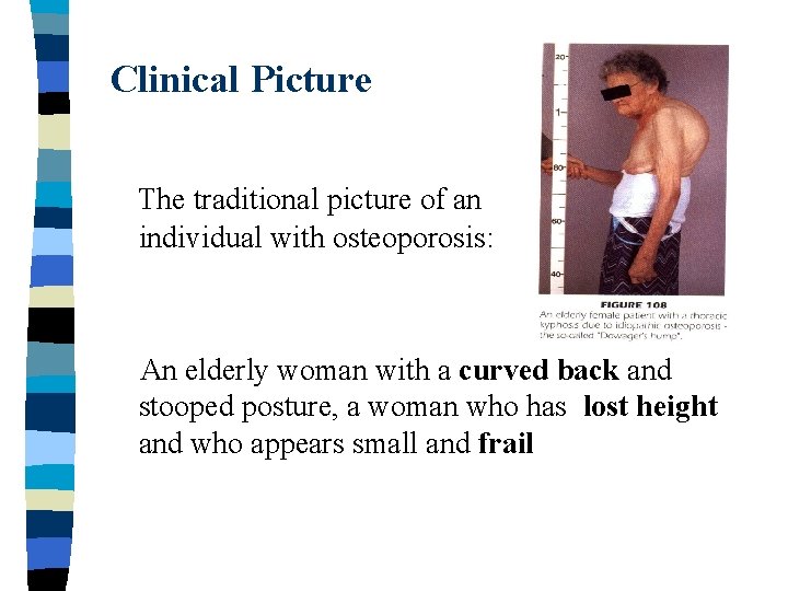 Clinical Picture The traditional picture of an individual with osteoporosis: An elderly woman with