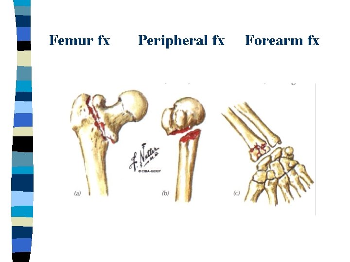 Femur fx Peripheral fx Forearm fx 