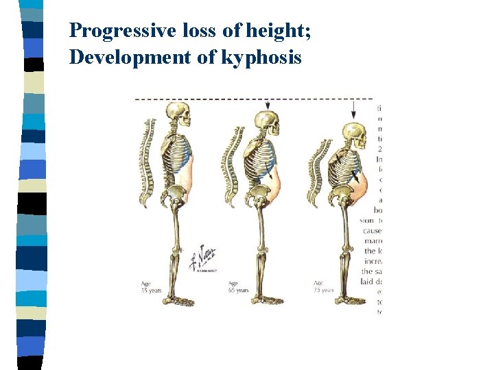 Progressive loss of height; Development of kyphosis 