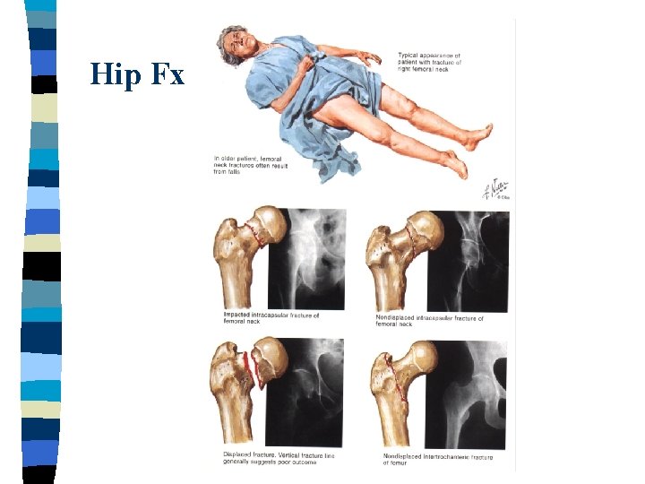 Hip Fx 