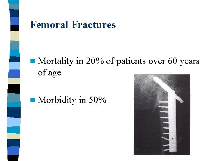 Femoral Fractures n Mortality in 20% of patients over 60 years of age n