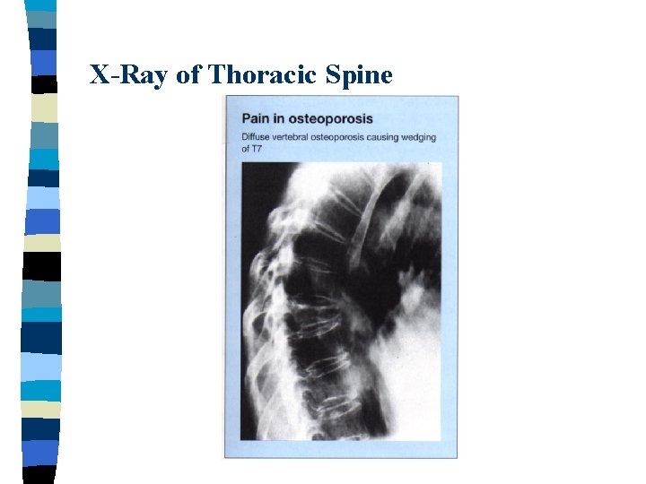 X-Ray of Thoracic Spine 