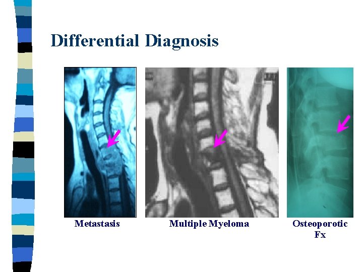 Differential Diagnosis Metastasis Multiple Myeloma Osteoporotic Fx 