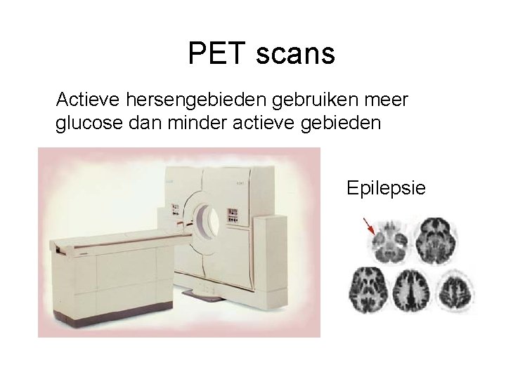 PET scans Actieve hersengebieden gebruiken meer glucose dan minder actieve gebieden Epilepsie 