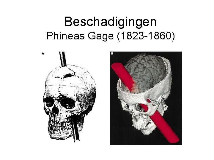 Beschadigingen Phineas Gage (1823 -1860) 