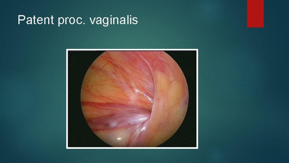 Patent proc. vaginalis Patent proc. vaginalis