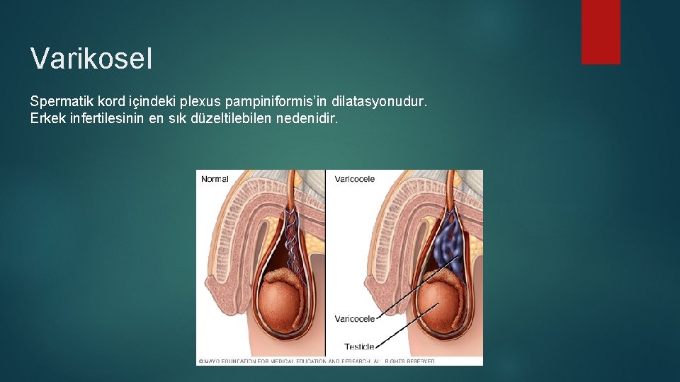 Varikosel Spermatik kord içindeki plexus pampiniformis’in dilatasyonudur. Erkek infertilesinin en sık düzeltilebilen nedenidir. Varikosel Spermatik kord içindeki plexus pampiniformis’in dilatasyonudur. Erkek infertilesinin en sık düzeltilebilen nedenidir.