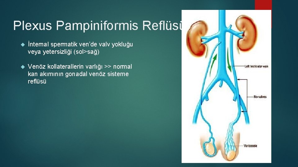 Plexus Pampiniformis Reflüsü İnternal spermatik ven’de valv yokluğu veya yetersizliği (sol>sağ) Venöz kollaterallerin varlığı Plexus Pampiniformis Reflüsü İnternal spermatik ven’de valv yokluğu veya yetersizliği (sol>sağ) Venöz kollaterallerin varlığı
