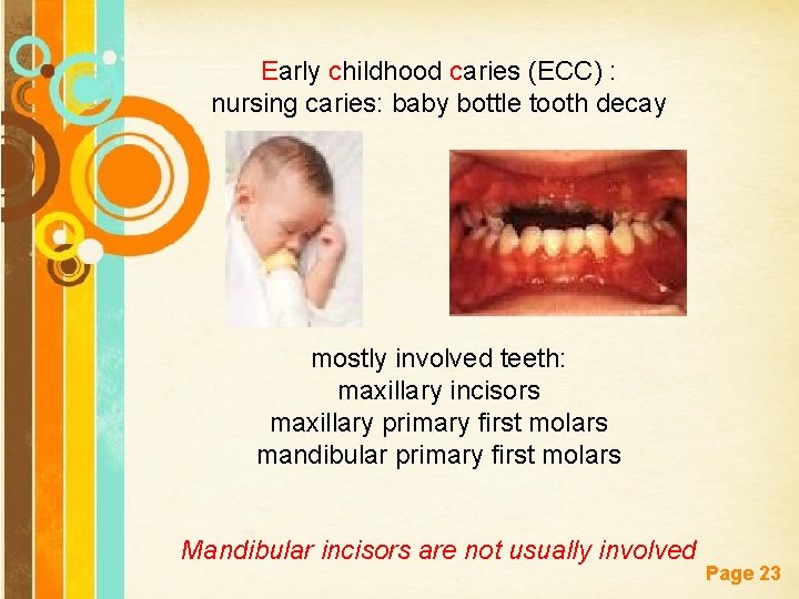 Early childhood caries (ECC) : nursing caries: baby bottle tooth decay mostly involved teeth: