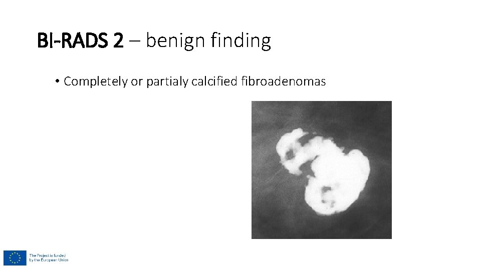 BI-RADS 2 – benign finding • Completely or partialy calcified fibroadenomas 
