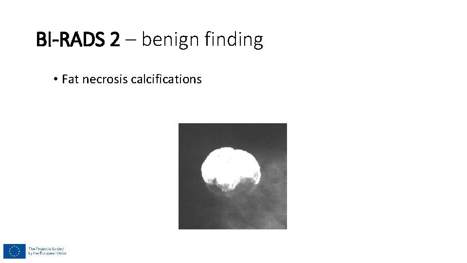 BI-RADS 2 – benign finding • Fat necrosis calcifications BI-RADS 2 – benign finding • Fat necrosis calcifications