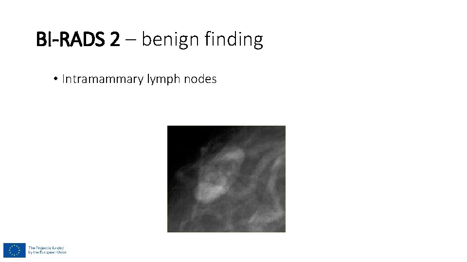 BI-RADS 2 – benign finding • Intramammary lymph nodes BI-RADS 2 – benign finding • Intramammary lymph nodes