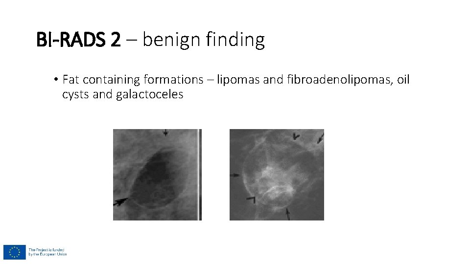 BI-RADS 2 – benign finding • Fat containing formations – lipomas and fibroadenolipomas, oil BI-RADS 2 – benign finding • Fat containing formations – lipomas and fibroadenolipomas, oil