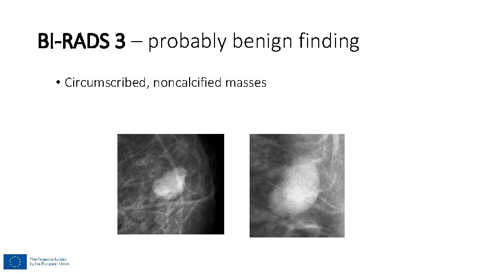 BI-RADS 3 – probably benign finding • Circumscribed, noncalcified masses 