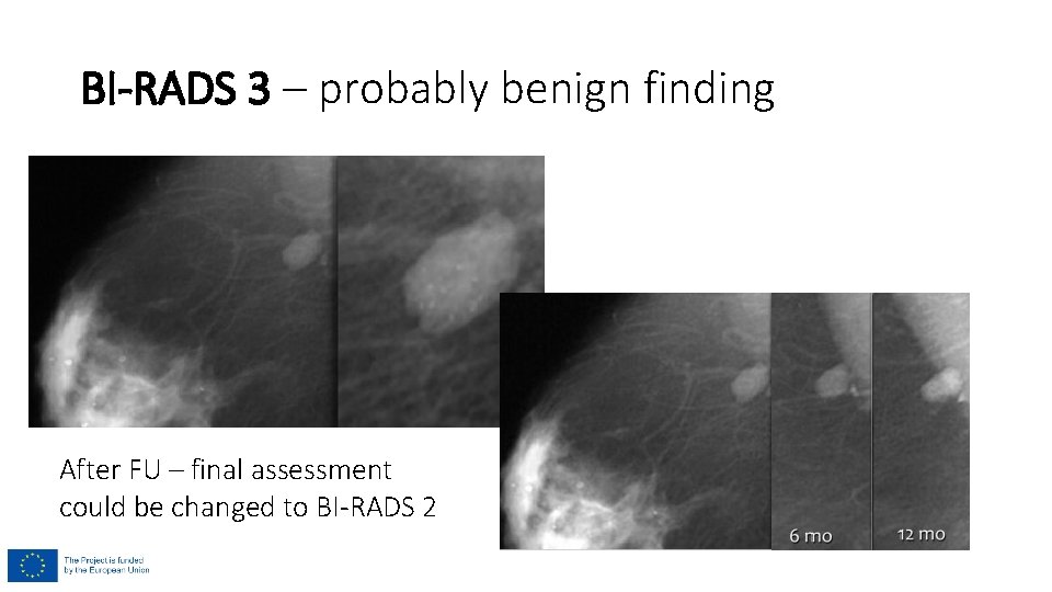BI-RADS 3 – probably benign finding After FU – final assessment could be changed BI-RADS 3 – probably benign finding After FU – final assessment could be changed