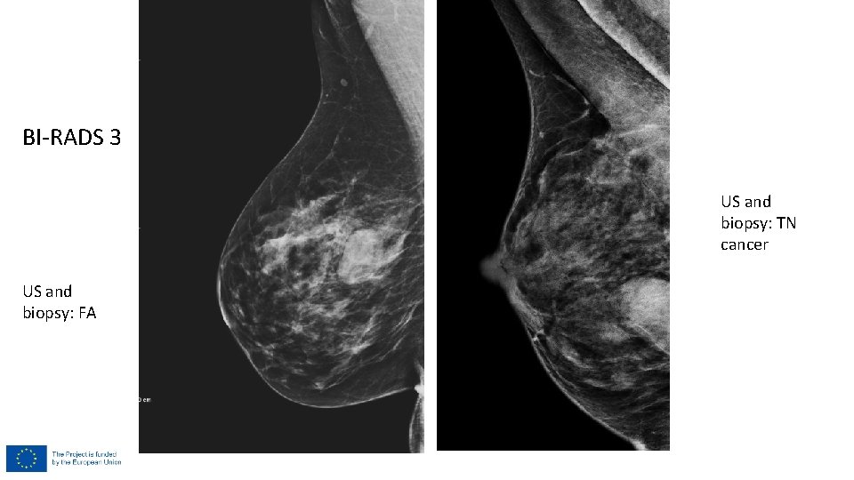 BI-RADS 3 US and biopsy: TN cancer US and biopsy: FA 