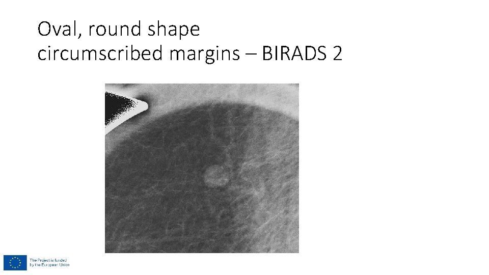 Oval, round shape circumscribed margins – BIRADS 2 