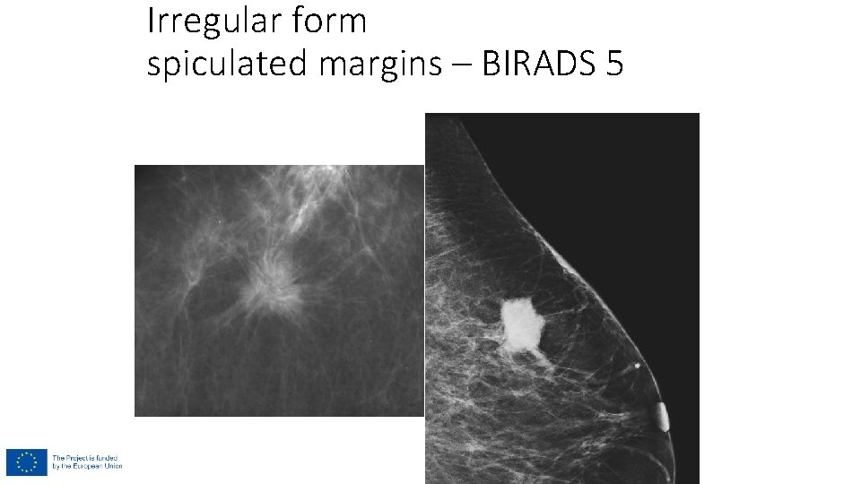 Irregular form spiculated margins – BIRADS 5 Irregular form spiculated margins – BIRADS 5