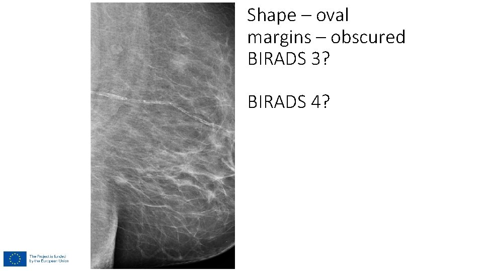 Shape – oval margins – obscured BIRADS 3? BIRADS 4? 