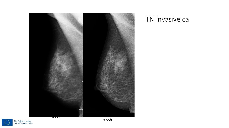 TN invasive ca 2007 2008 