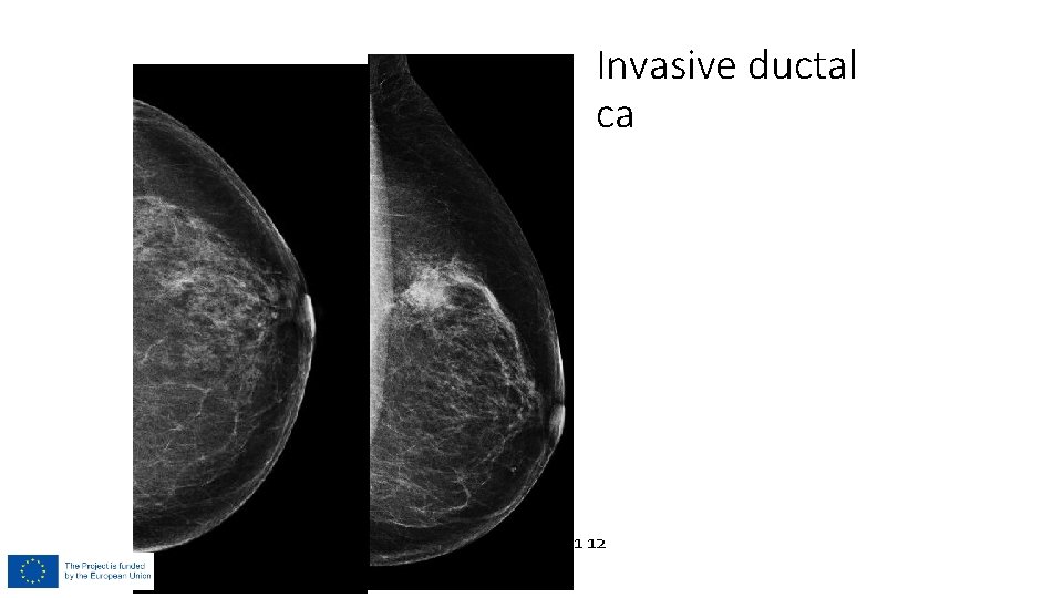 Invasive ductal ca 2011 03 2011 12 