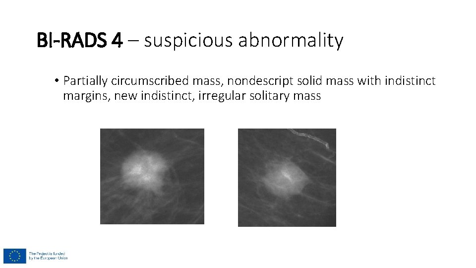 BI-RADS 4 – suspicious abnormality • Partially circumscribed mass, nondescript solid mass with indistinct