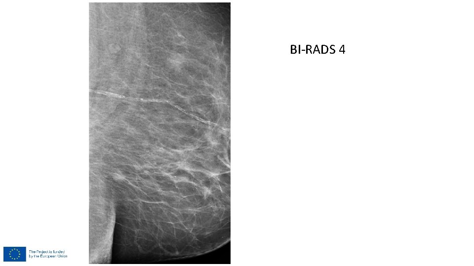 BI-RADS 4 BI-RADS 4