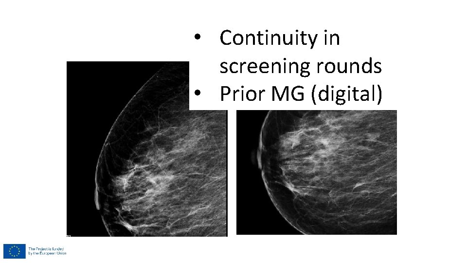 • Continuity in screening rounds • Prior MG (digital) • Continuity in screening rounds • Prior MG (digital)