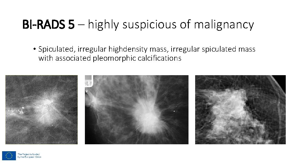 BI-RADS 5 – highly suspicious of malignancy • Spiculated, irregular highdensity mass, irregular spiculated