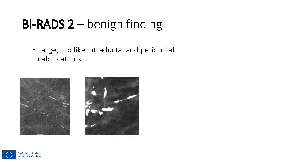 BI-RADS 2 – benign finding • Large, rod like intraductal and periductal calcifications BI-RADS 2 – benign finding • Large, rod like intraductal and periductal calcifications
