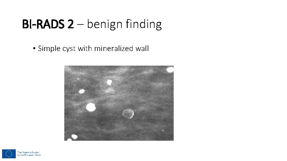 BI-RADS 2 – benign finding • Simple cyst with mineralized wall 