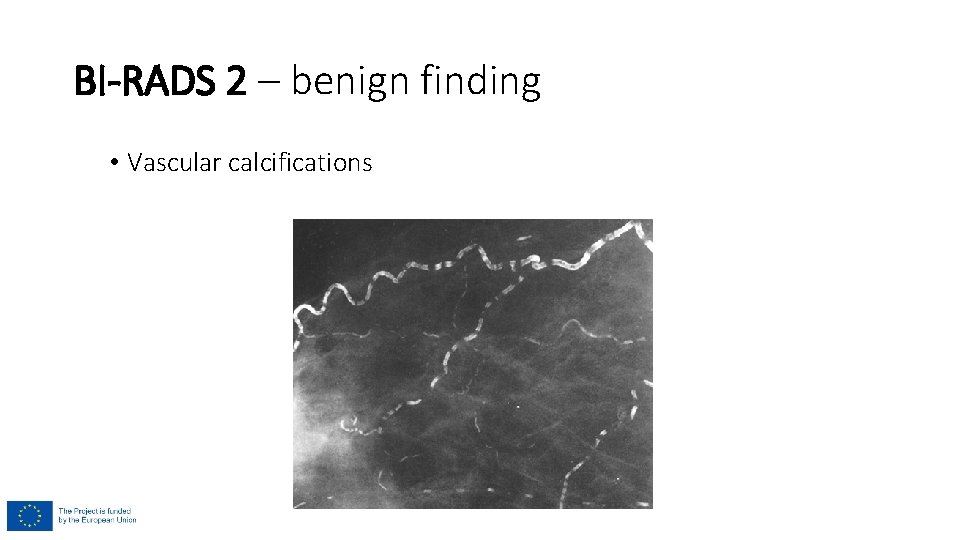 BI-RADS 2 – benign finding • Vascular calcifications 