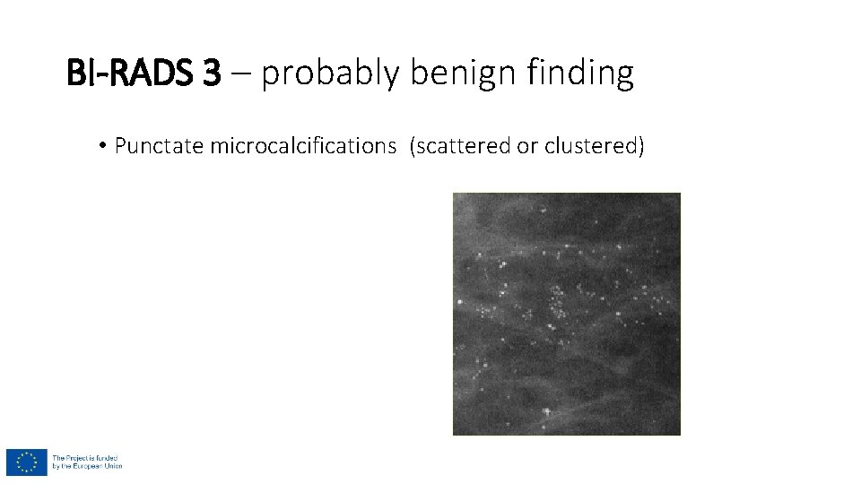 BI-RADS 3 – probably benign finding • Punctate microcalcifications (scattered or clustered) 