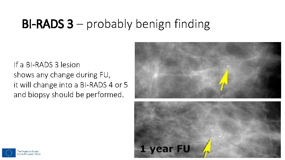 BI-RADS 3 – probably benign finding If a BI-RADS 3 lesion shows any change