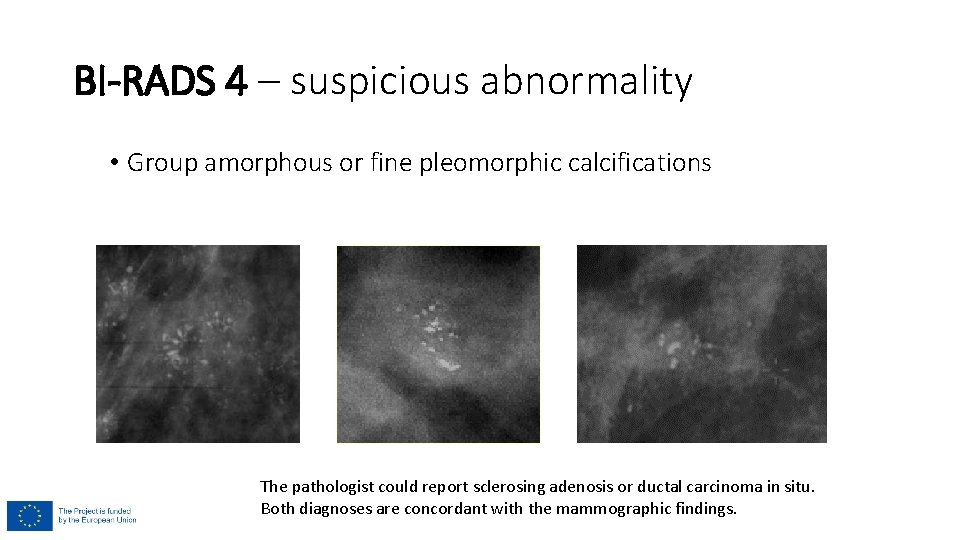 BI-RADS 4 – suspicious abnormality • Group amorphous or fine pleomorphic calcifications The pathologist BI-RADS 4 – suspicious abnormality • Group amorphous or fine pleomorphic calcifications The pathologist