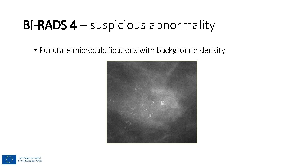 BI-RADS 4 – suspicious abnormality • Punctate microcalcifications with background density BI-RADS 4 – suspicious abnormality • Punctate microcalcifications with background density
