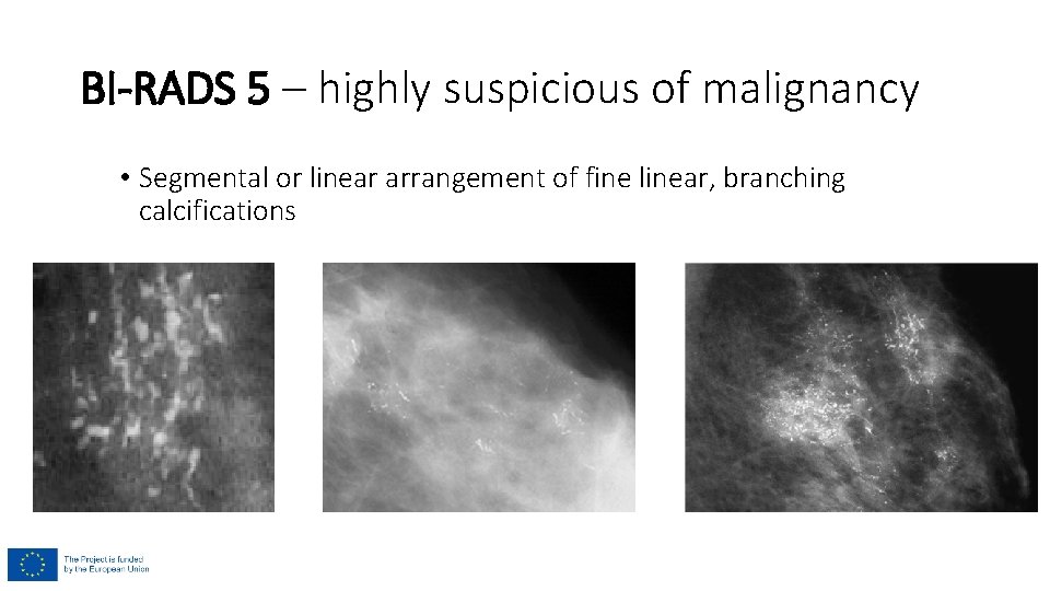 BI-RADS 5 – highly suspicious of malignancy • Segmental or linear arrangement of fine BI-RADS 5 – highly suspicious of malignancy • Segmental or linear arrangement of fine
