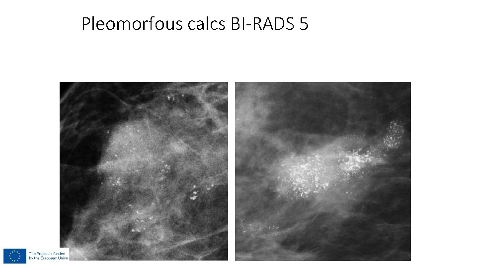 Pleomorfous calcs BI-RADS 5 Pleomorfous calcs BI-RADS 5