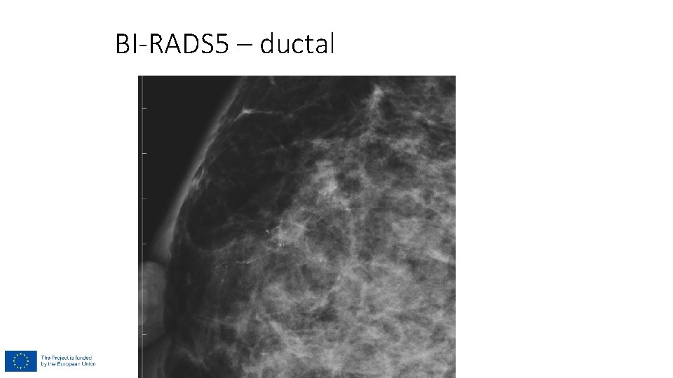 BI-RADS 5 – ductal 