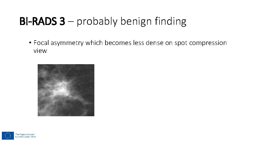 BI-RADS 3 – probably benign finding • Focal asymmetry which becomes less dense on BI-RADS 3 – probably benign finding • Focal asymmetry which becomes less dense on