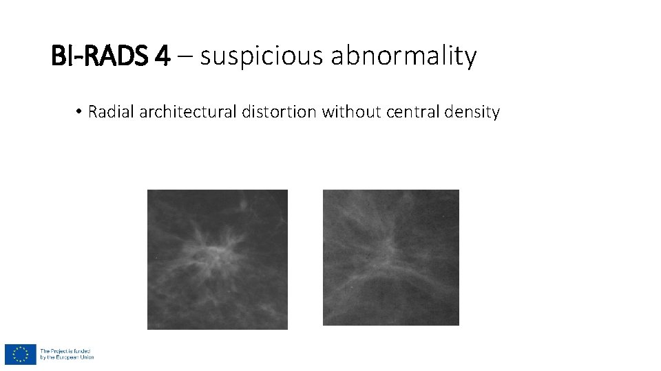 BI-RADS 4 – suspicious abnormality • Radial architectural distortion without central density 