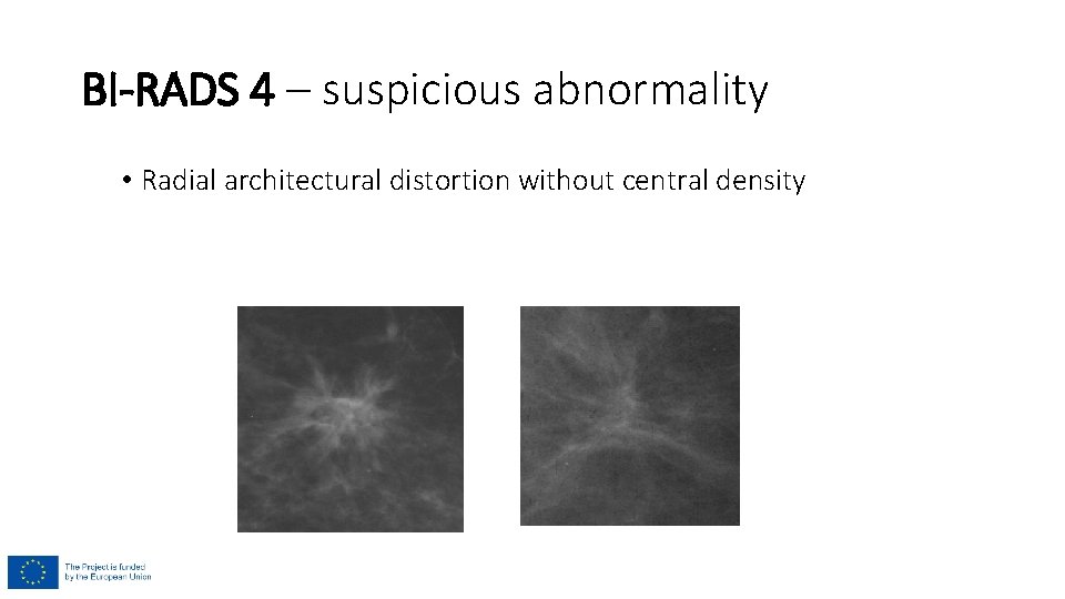 BI-RADS 4 – suspicious abnormality • Radial architectural distortion without central density BI-RADS 4 – suspicious abnormality • Radial architectural distortion without central density