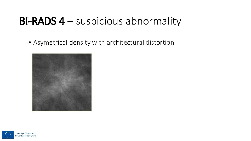 BI-RADS 4 – suspicious abnormality • Asymetrical density with architectural distortion 