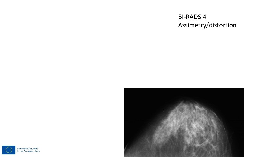 BI-RADS 4 Assimetry/distortion BI-RADS 4 Assimetry/distortion