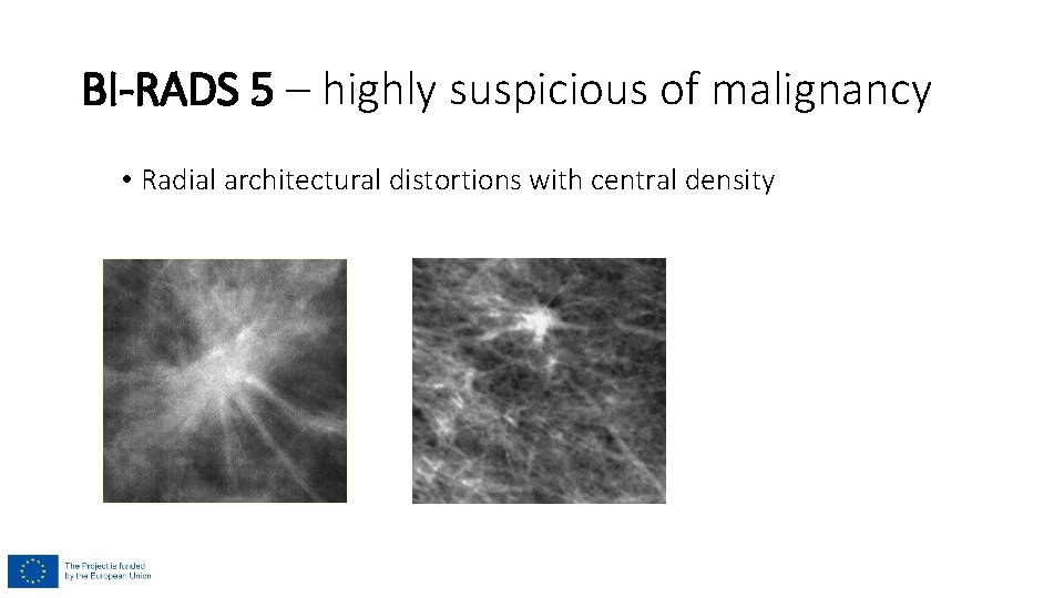 BI-RADS 5 – highly suspicious of malignancy • Radial architectural distortions with central density BI-RADS 5 – highly suspicious of malignancy • Radial architectural distortions with central density