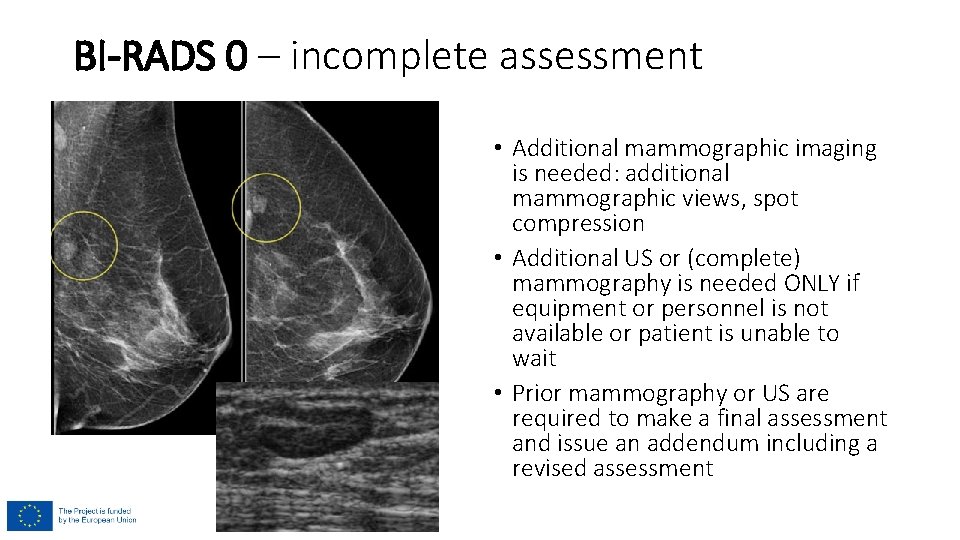 BI-RADS 0 – incomplete assessment • Additional mammographic imaging is needed: additional mammographic views,