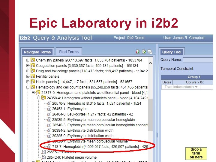 Epic Laboratory in i 2 b 2 Maps LRR CLARITY_COMPONENT 1534435|“Hemoglobin”|”HGB”|LOINC: 718 -7| Record